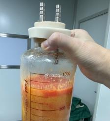 台州水动力吸脂手术要做多久？